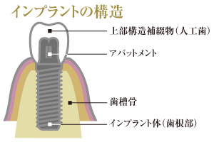 インプラントイメージ